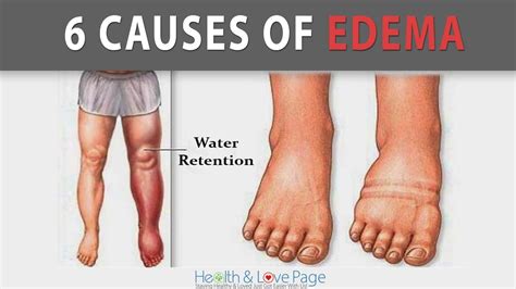 legs leaking fluid|Edema: Causes, Symptoms & Treatment